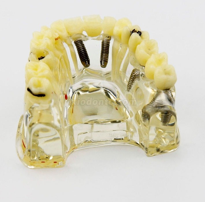 Modelo de implante dentário de mandíbula superior com ponte e cárie -I 2006