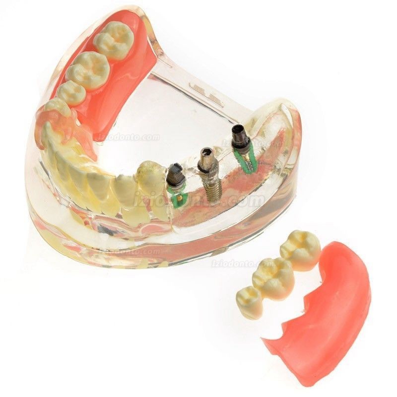 Restauração de implante de contraste de modelo dentário para dentes molares ausentes M-6006