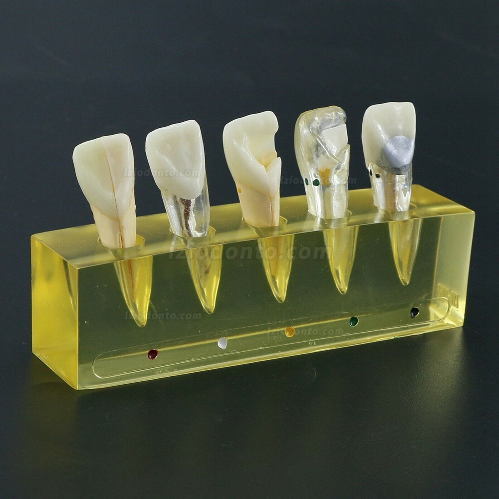 Dentes dentais modelo 5 estágios demonstração tratamento endodôntico incisivo do canal radicular