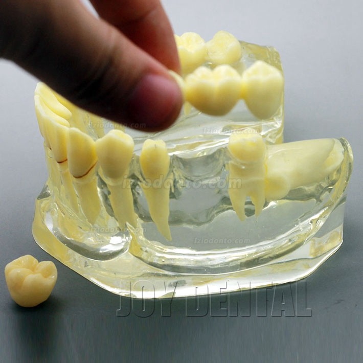 Restauração dentária ampliada / prótese / modelo de estudo de implante com ponte