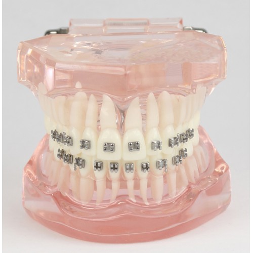 Maloclusão de dentes dentais correta com suporte de metal modelo padrão M3001