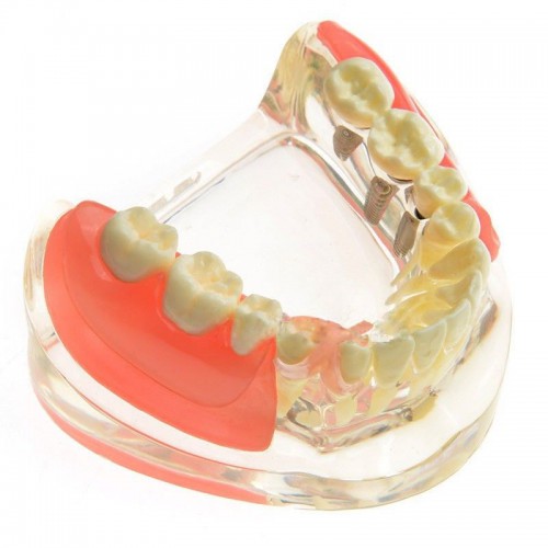 Restauração de implante de contraste de modelo dentário para dentes molares ausentes M-6006