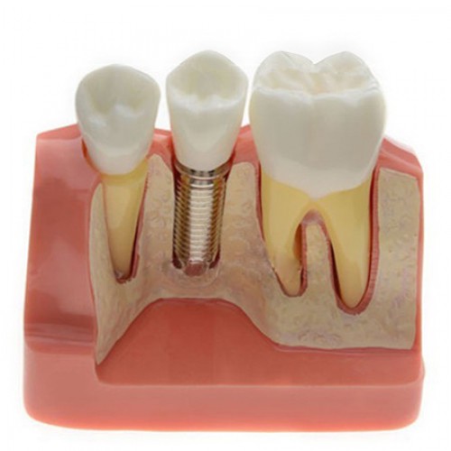 Análise de modelo para implante dentário M2017