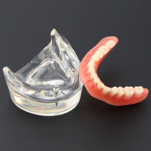 Dentes dentais modelo sobredentadura inferior com 2 implantes 6002 01