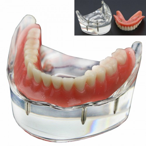 Dentes Inferiores Dentais Modelo 6002 02 Sobredentadura com 4 Implantes