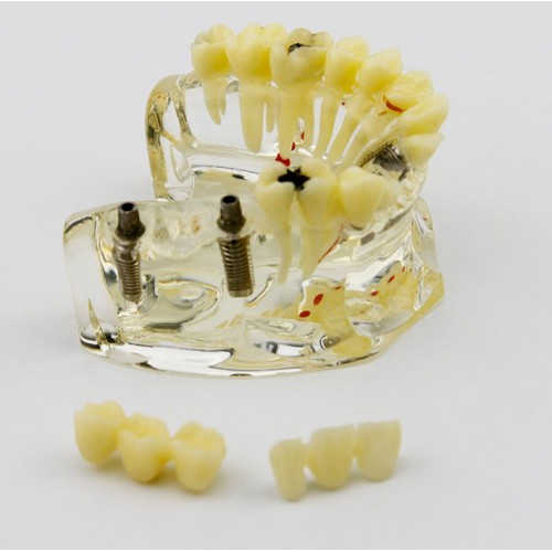 Modelo de implante dentário de mandíbula superior com ponte e cárie -I 2006