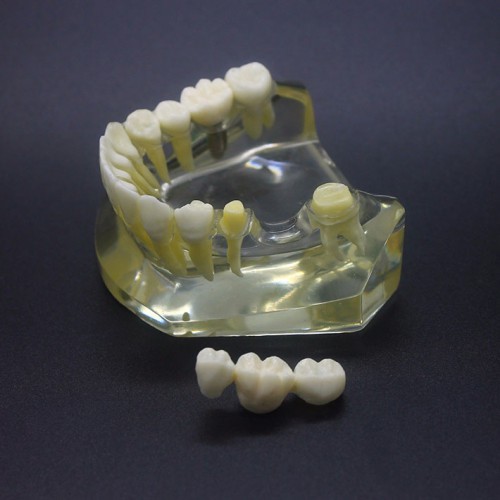 Estudo de Implante Dentário Modelo Typodont Modelo Inferior 2010