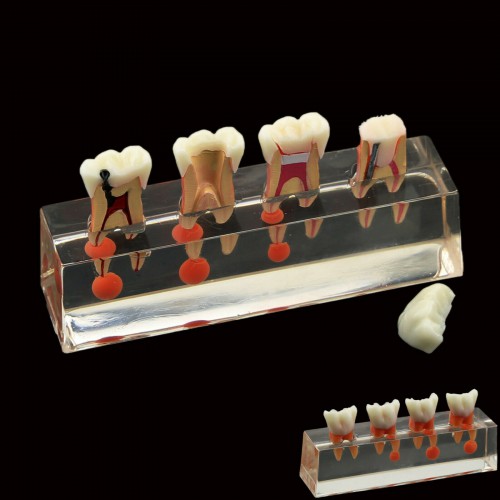 Tratamento endodôntico de 4 estágios modelo de dentes dentais demonstra M4018 anatômico