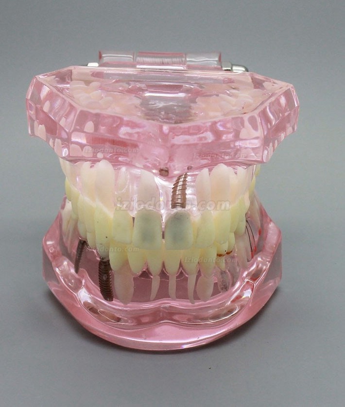 Demonstração de análise de estudo de implante dentário Modelo de dente com restauração rosa