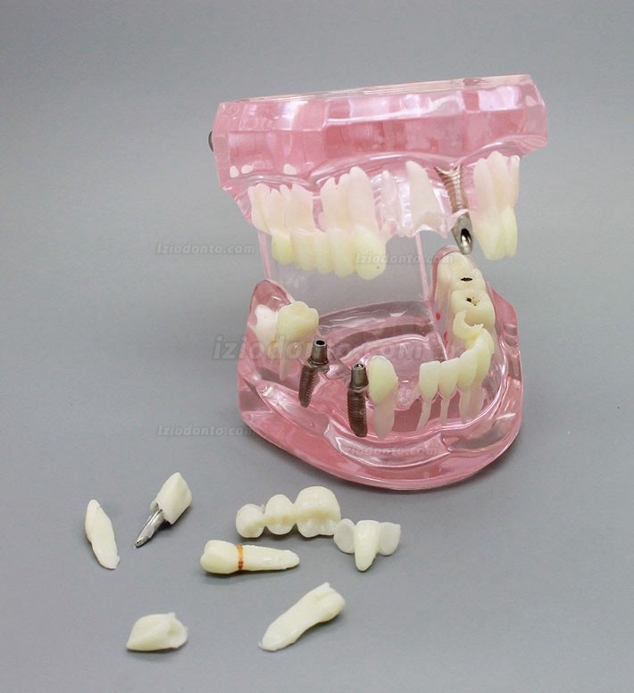 Demonstração de análise de estudo de implante dentário Modelo de dente com restauração rosa