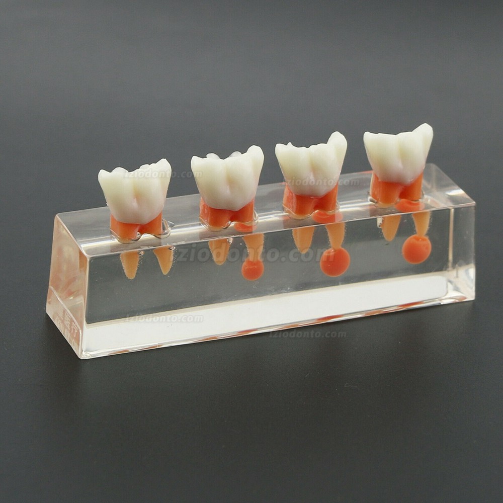 Tratamento endodôntico de 4 estágios modelo de dentes dentais demonstra M4018 anatômico