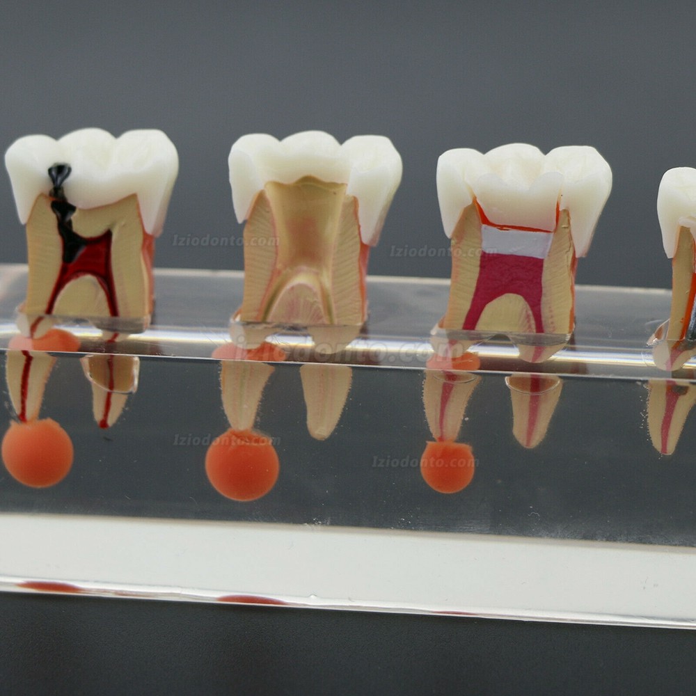 Tratamento endodôntico de 4 estágios modelo de dentes dentais demonstra M4018 anatômico