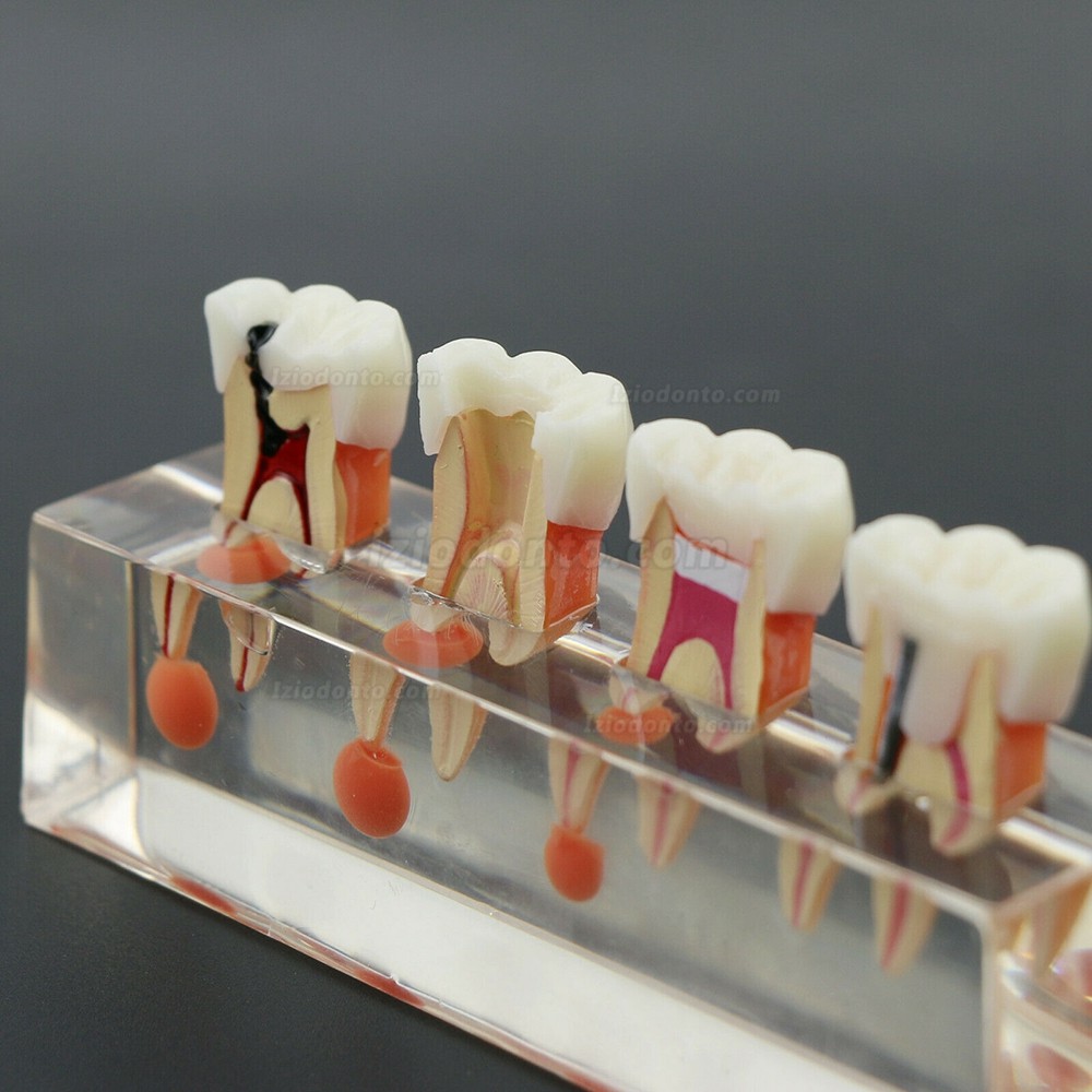 Tratamento endodôntico de 4 estágios modelo de dentes dentais demonstra M4018 anatômico
