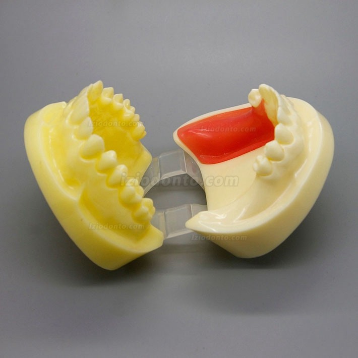 Modelo de prática de cirurgia de implante dentário com gengiva substituível 2002