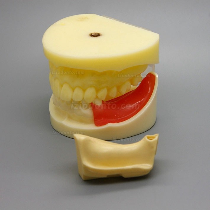 Modelo de prática de cirurgia de implante dentário com gengiva substituível 2002