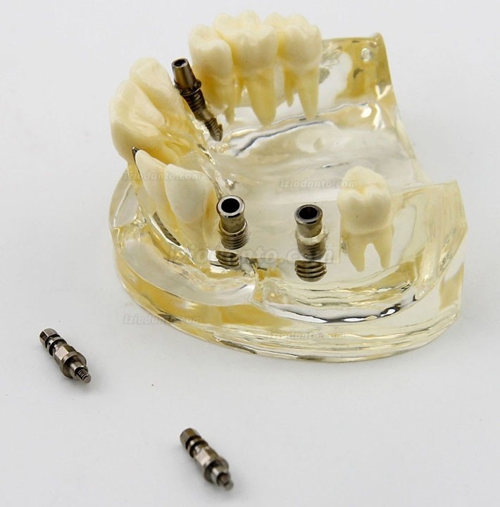 Estudo de cirurgia de implante dentário da mandíbula superior Modelo Dem 2005