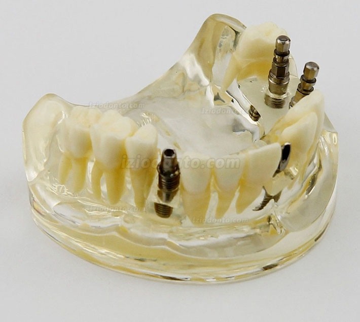Estudo de cirurgia de implante dentário da mandíbula superior Modelo Dem 2005