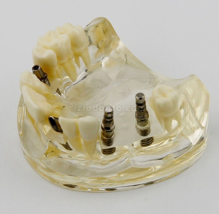 Estudo de cirurgia de implante dentário da mandíbula superior Modelo Dem 2005