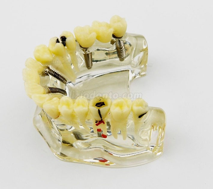 Modelo de implante dentário de mandíbula superior com ponte e cárie -I 2006