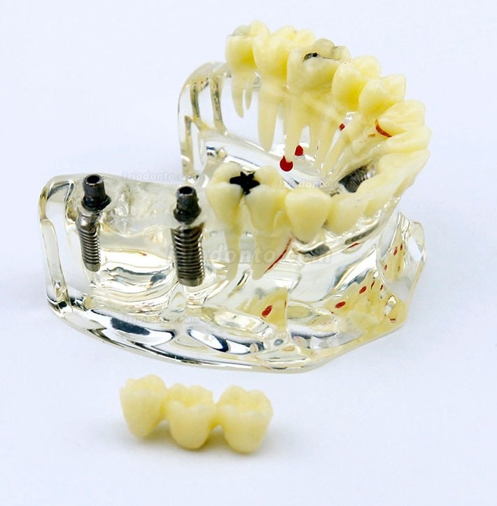 Modelo de implante dentário de mandíbula superior com ponte e cárie -I 2006