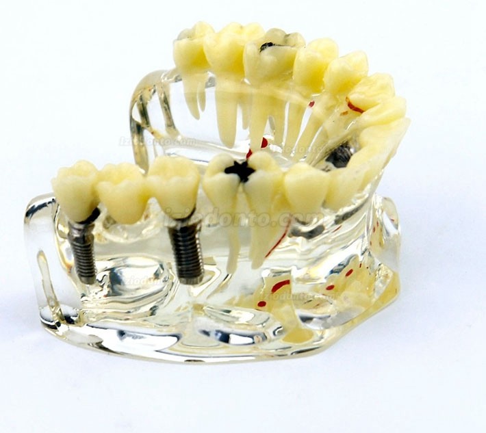 Modelo de implante dentário de mandíbula superior com ponte e cárie -I 2006