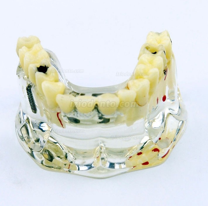 Modelo de implante dentário de mandíbula superior com ponte e cárie -I 2006