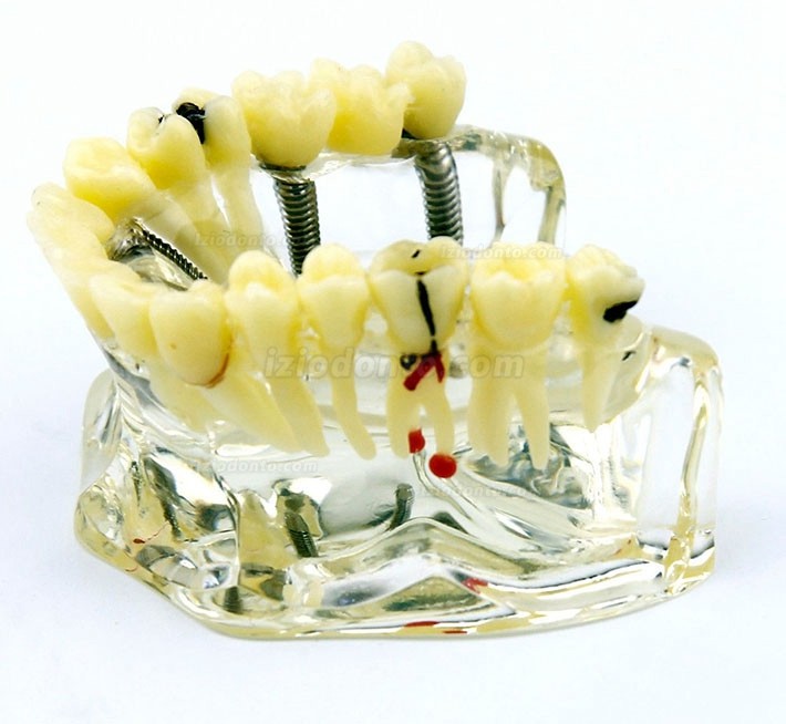 Modelo de implante dentário de mandíbula superior com ponte e cárie -I 2006