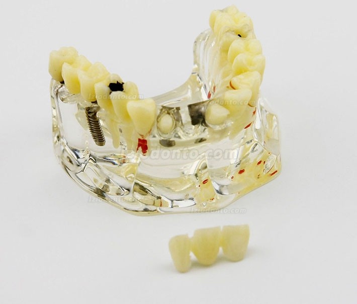 Modelo de implante dentário de mandíbula superior com ponte e cárie -I 2006