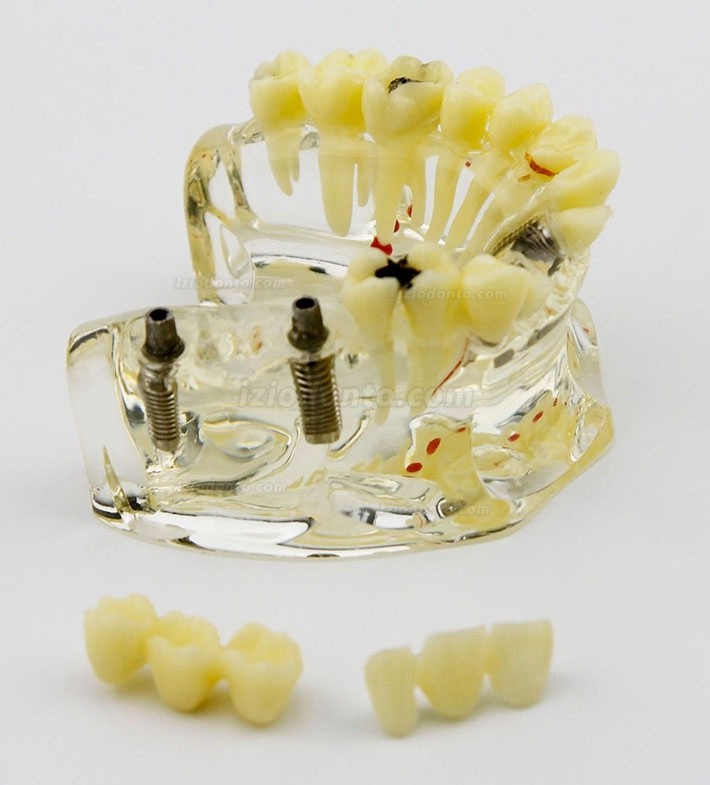 Modelo de implante dentário de mandíbula superior com ponte e cárie -I 2006