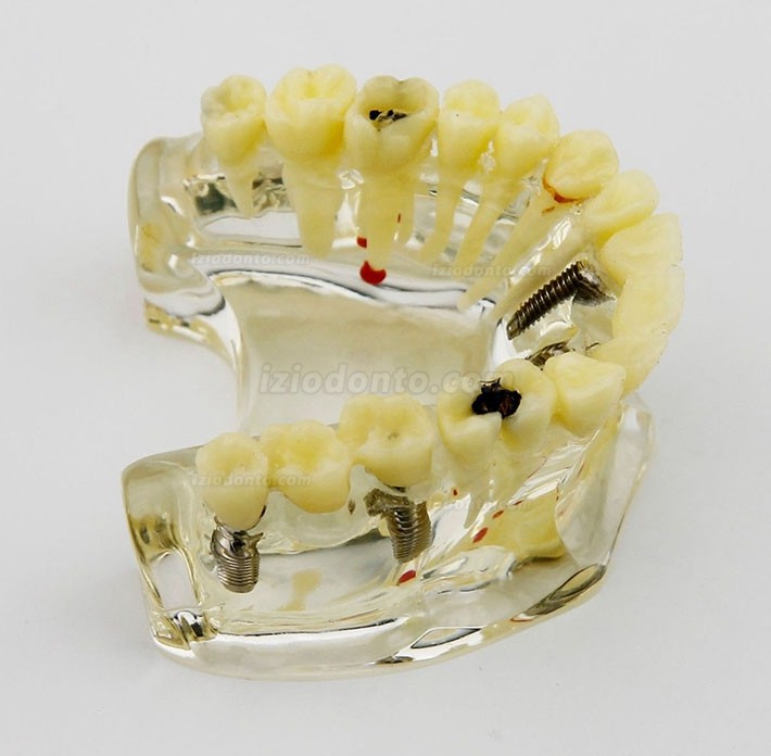 Modelo de implante dentário de mandíbula superior com ponte e cárie -I 2006