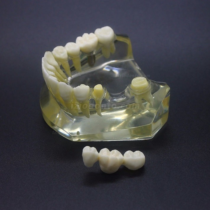 Estudo de Implante Dentário Modelo Typodont Modelo Inferior 2010