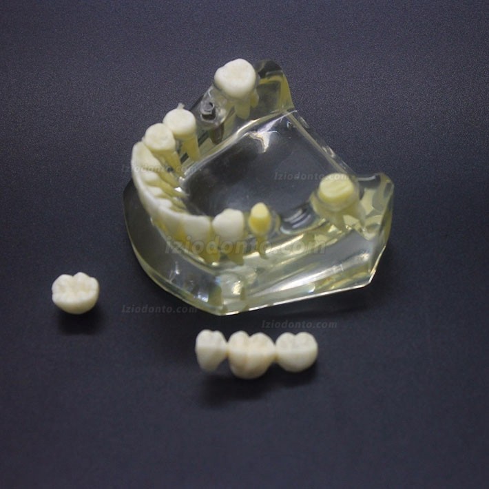 Estudo de Implante Dentário Modelo Typodont Modelo Inferior 2010