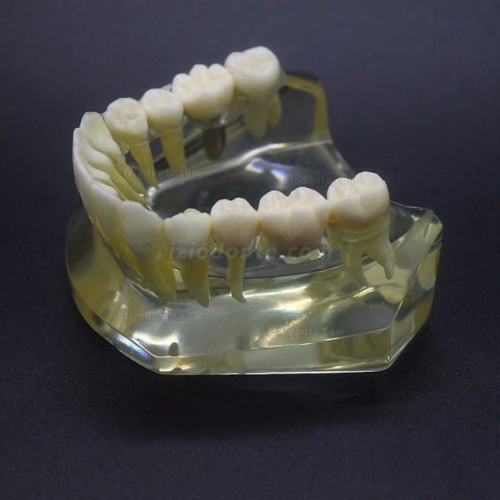 Estudo de Implante Dentário Modelo Typodont Modelo Inferior 2010