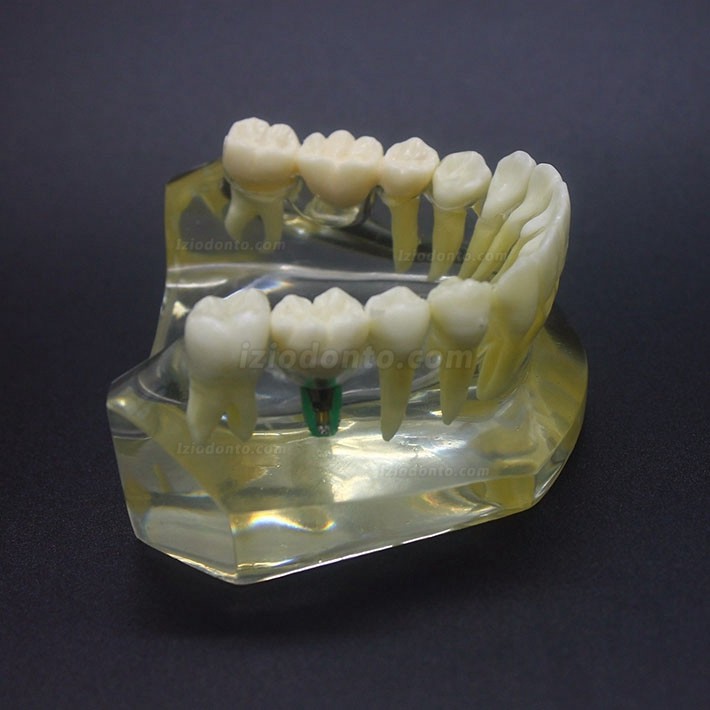 Estudo de Implante Dentário Modelo Typodont Modelo Inferior 2010