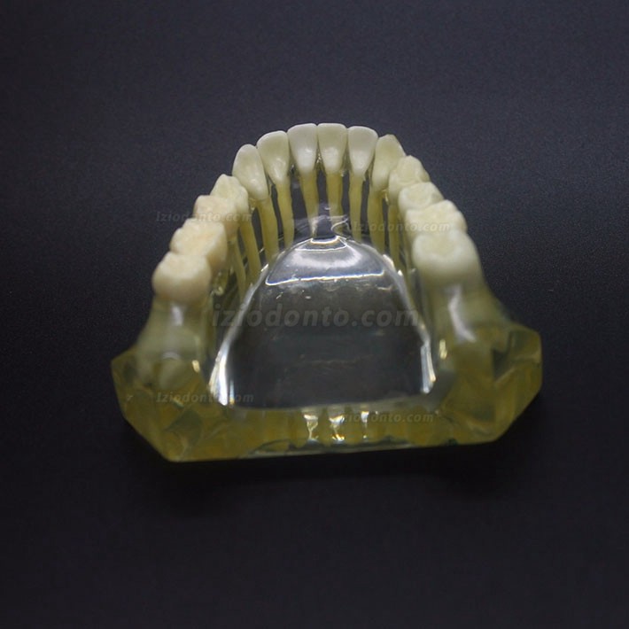 Estudo de Implante Dentário Modelo Typodont Modelo Inferior 2010