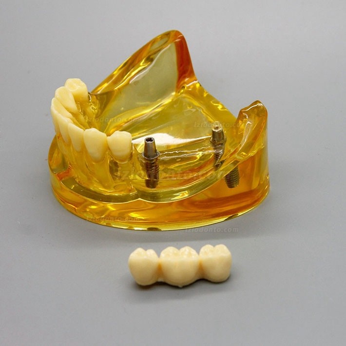 Modelo de implante dentário de mandíbula inferior com 2 pontes de implantes 2011