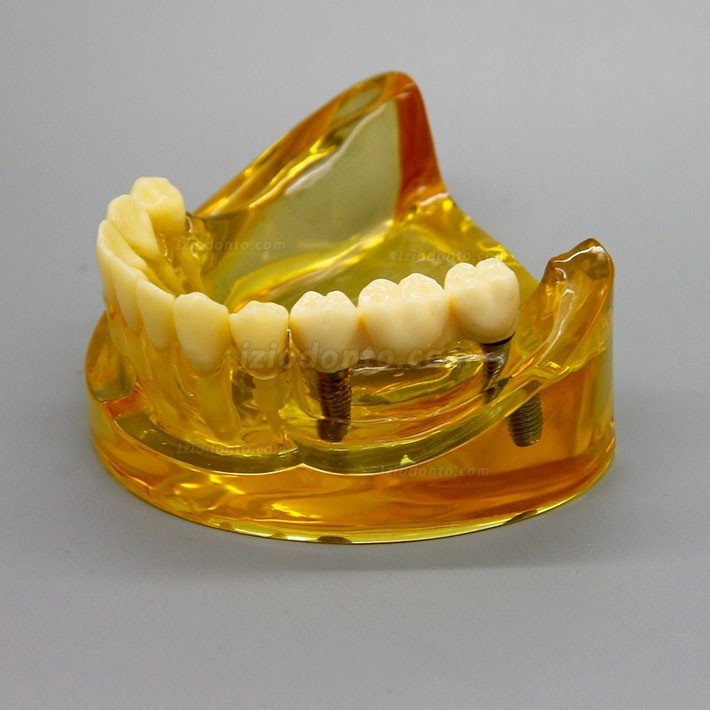 Modelo de implante dentário de mandíbula inferior com 2 pontes de implantes 2011