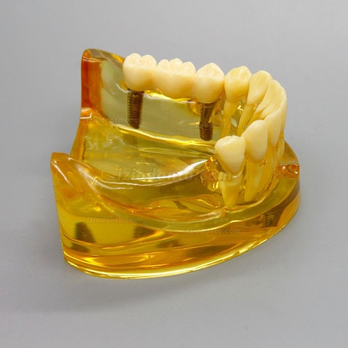 Modelo de implante dentário de mandíbula inferior com 2 pontes de implantes 2011