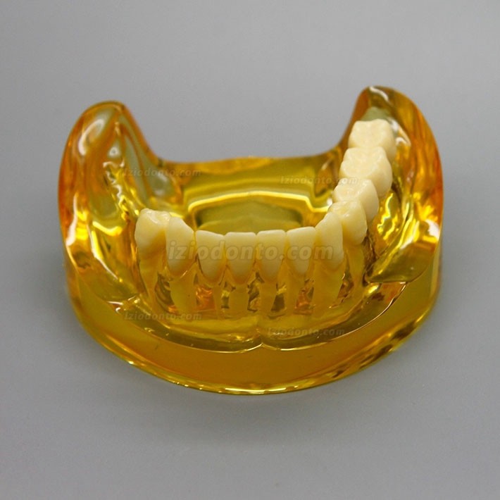 Modelo de implante dentário de mandíbula inferior com 2 pontes de implantes 2011