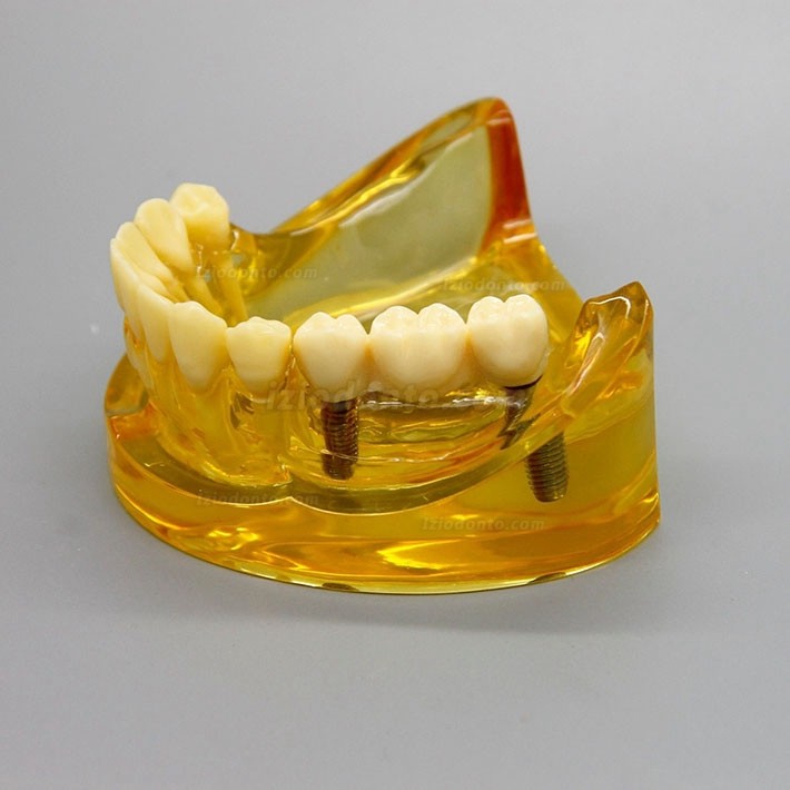 Modelo de implante dentário de mandíbula inferior com 2 pontes de implantes 2011