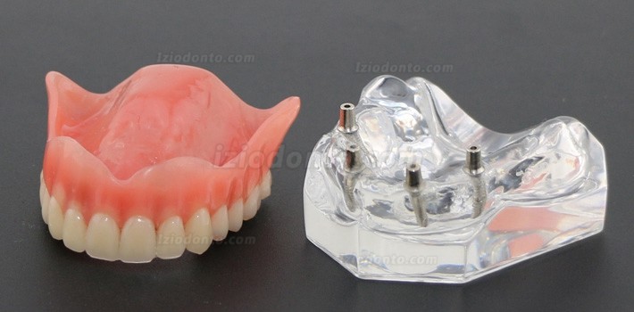 Dentes dentais modelo sobredentadura Superior com 4 implantes 6001