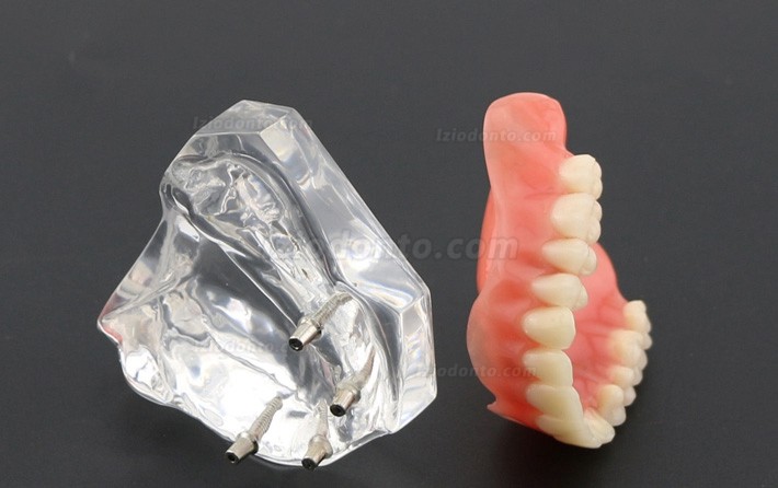 Dentes dentais modelo sobredentadura Superior com 4 implantes 6001