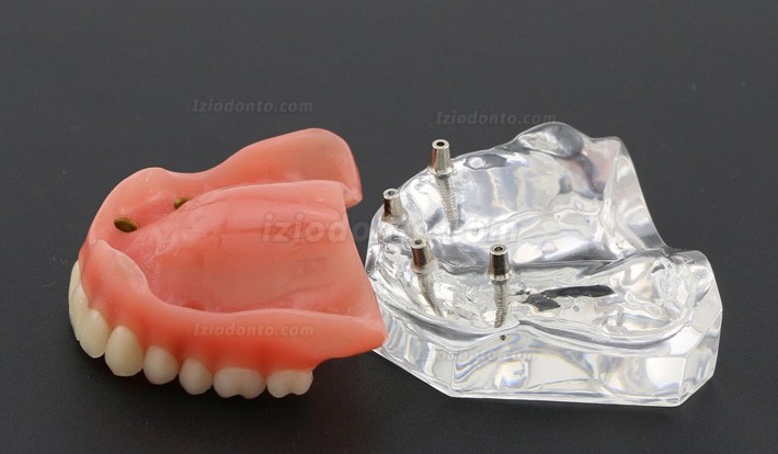 Dentes dentais modelo sobredentadura Superior com 4 implantes 6001