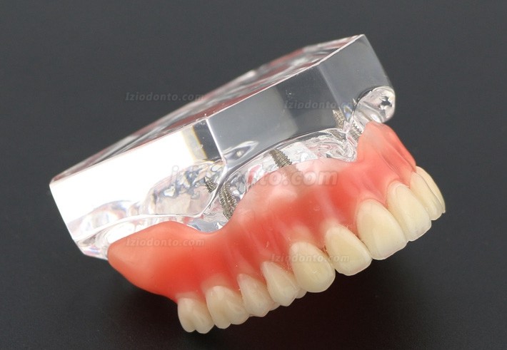 Dentes dentais modelo sobredentadura Superior com 4 implantes 6001