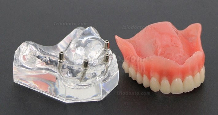 Dentes dentais modelo sobredentadura Superior com 4 implantes 6001