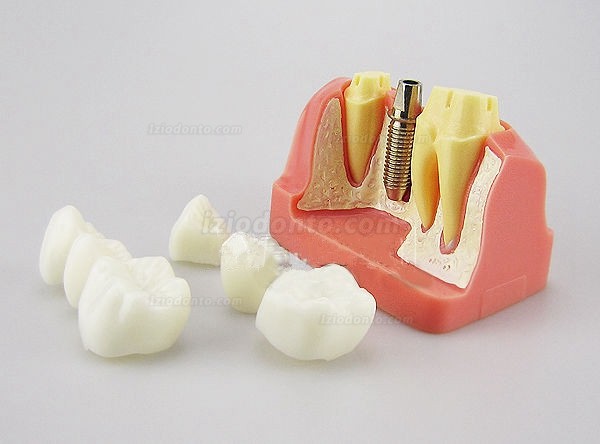 Análise de modelo para implante dentário M2017