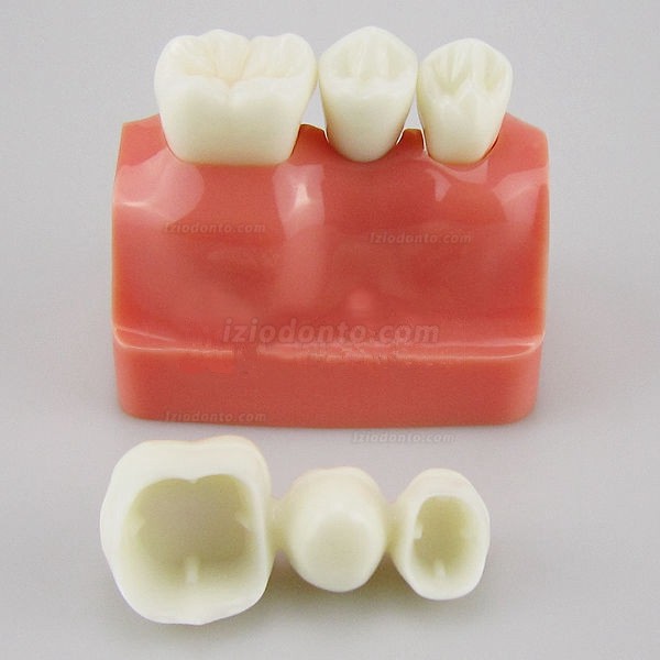 Análise de modelo para implante dentário M2017