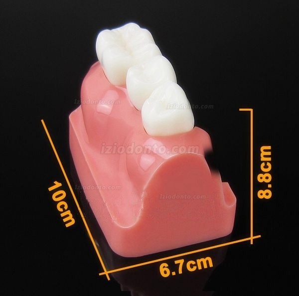 Análise de modelo para implante dentário M2017