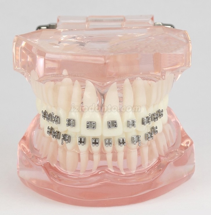 Maloclusão de dentes dentais correta com suporte de metal modelo padrão M3001