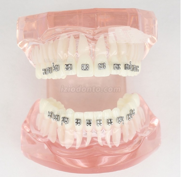 Maloclusão de dentes dentais correta com suporte de metal modelo padrão M3001